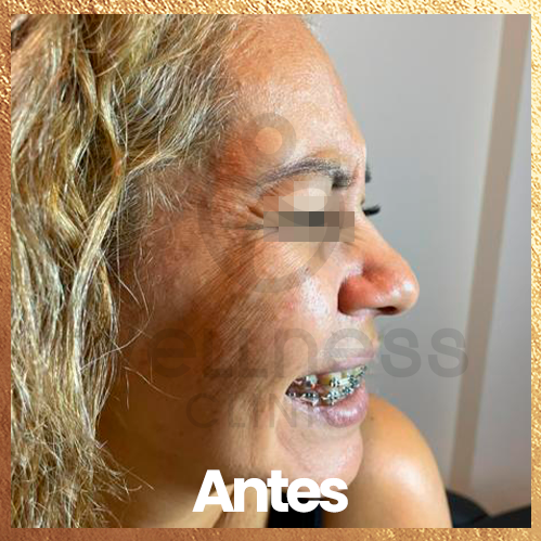 procedimiento antes. despues
