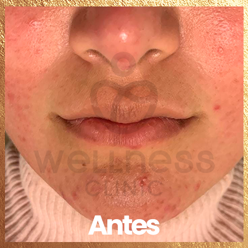 procedimiento filler de labios. antes