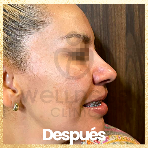 procedimiento botox. despues