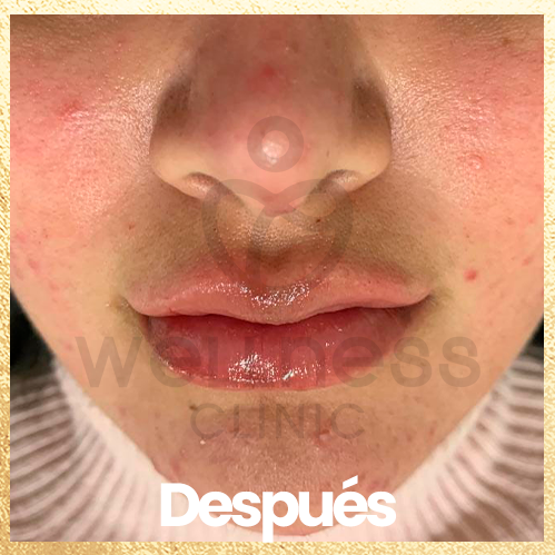 procedimiento filler de labios. despues
