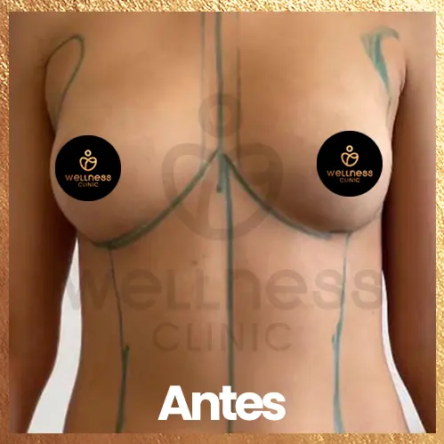 cirugia aumento de busto antes