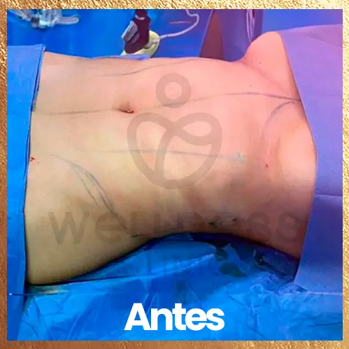 Procedimiento liposuccion y lipoinyeccion antes