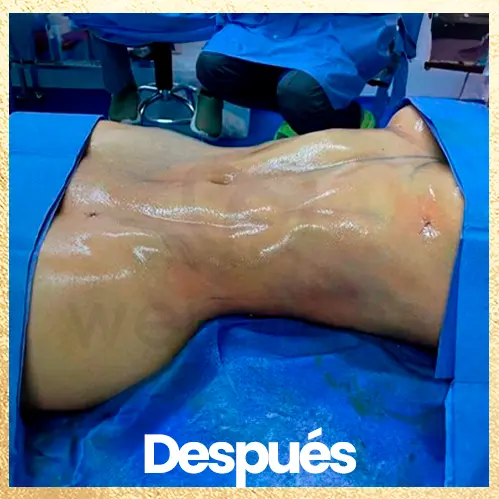 Procedimiento liposuccion y lipoinyeccion despues