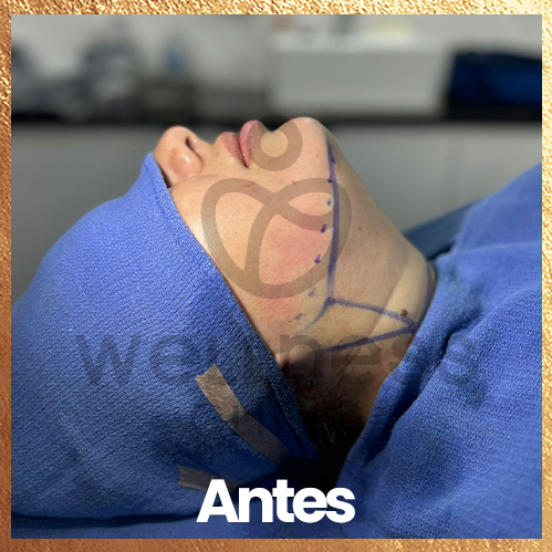 Lipopapada lipo de papada antes