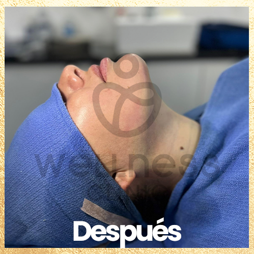 Lipopapada lipo de papada despues